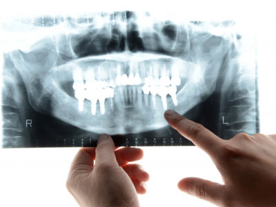 マウスピースは歯科医師によるカウンセリングや検査、型取り、レントゲンなどを実施して作成